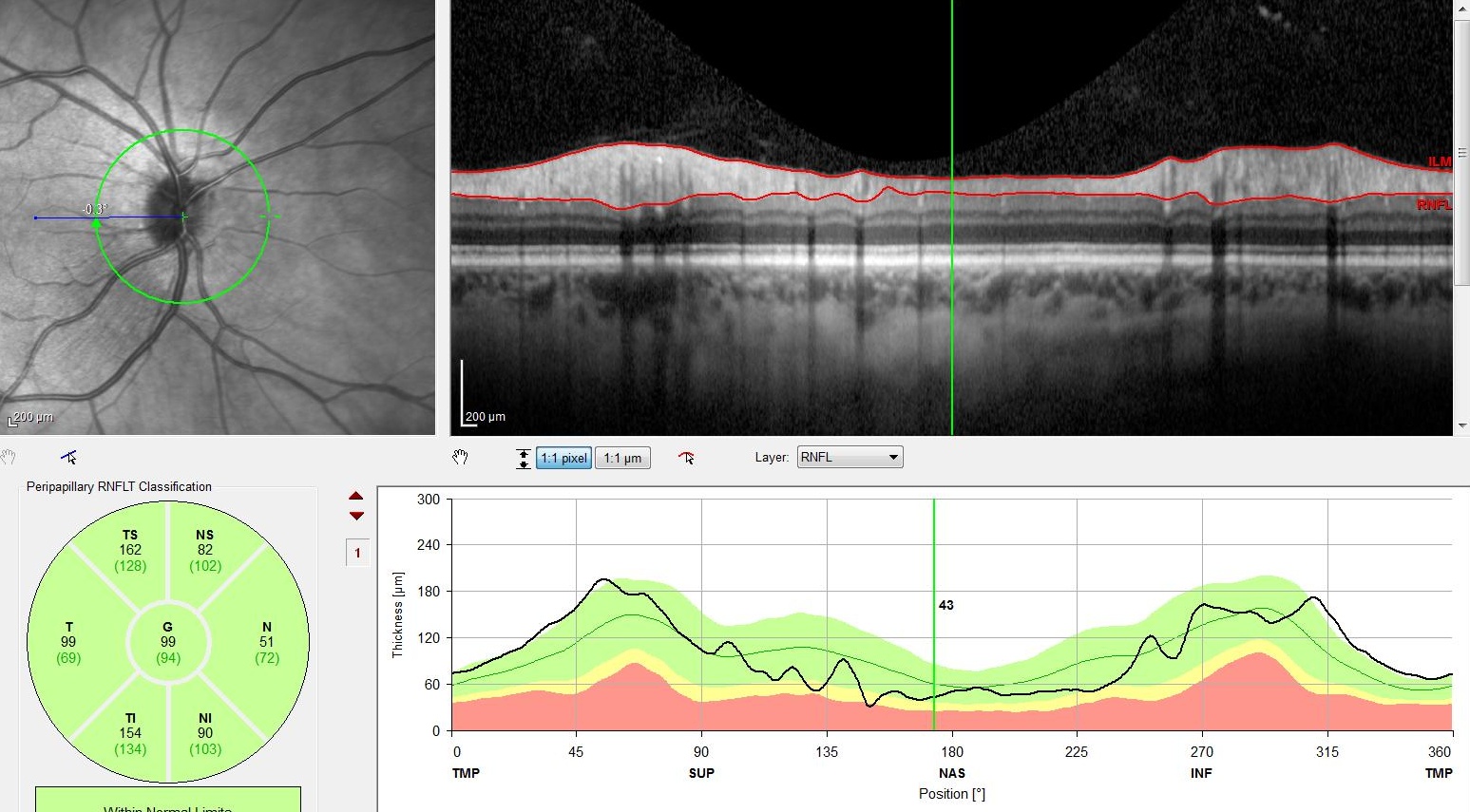 vyšetření tloušťky vrstvy nervových vláken při podezření na zelený zákal